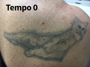 Rimozione tatuaggi - fase 0