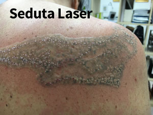 Rimozione tatuaggi - seduta laser